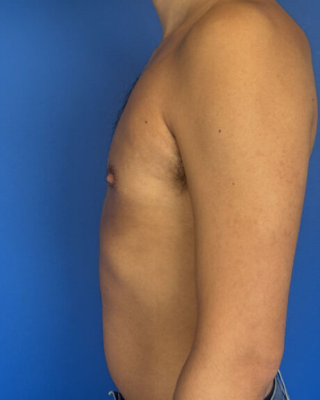 Gynecomastia case #3013