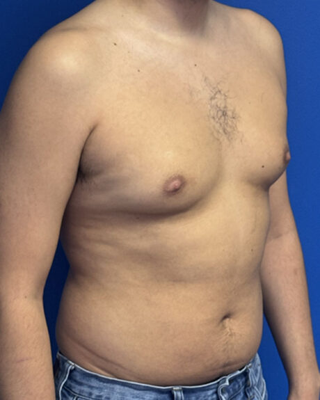 Gynecomastia case #3013