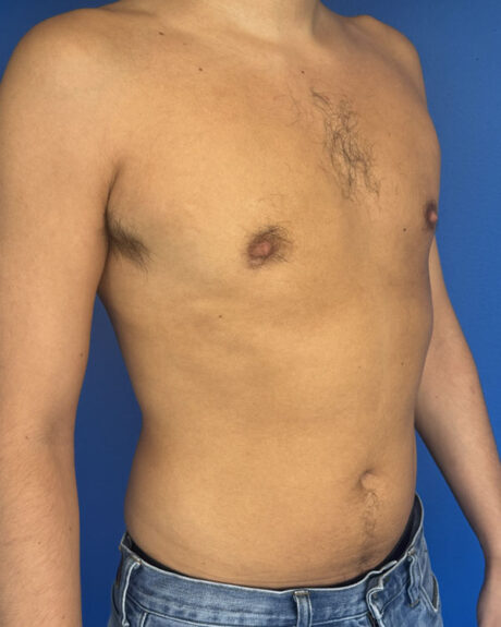 Gynecomastia case #3013