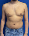 Gynecomastia case #3013