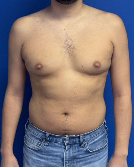 Gynecomastia case #3013