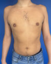 Gynecomastia case #3013