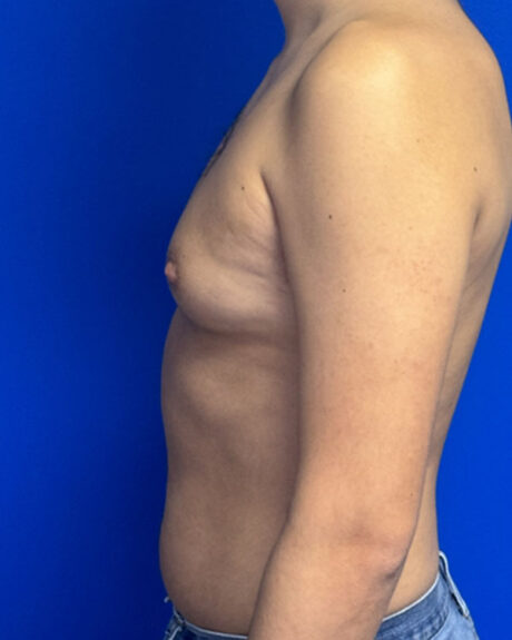 Gynecomastia case #3013