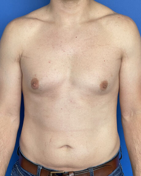 Gynecomastia case #3012