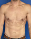 Gynecomastia case #3012