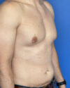 Gynecomastia case #3012