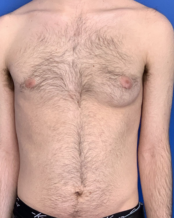 Gynecomastia case #3011