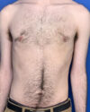 Gynecomastia case #3011