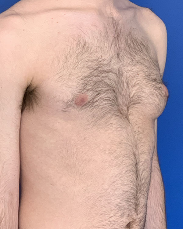 Gynecomastia case #3011