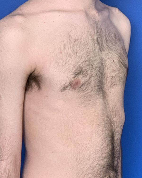 Gynecomastia case #3011