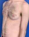 Gynecomastia case #3011