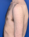 Gynecomastia case #3011