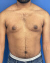 Gynecomastia case #3010