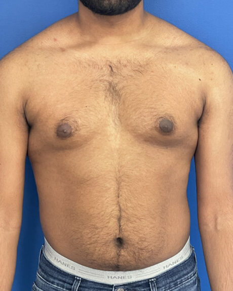 Gynecomastia case #3010