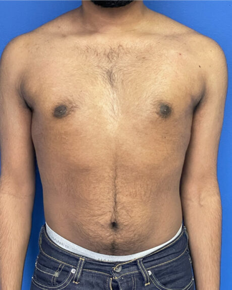 Gynecomastia case #3010