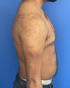 Gynecomastia case #3010