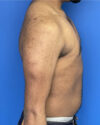 Gynecomastia case #3010