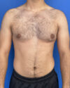 Gynecomastia case #3009