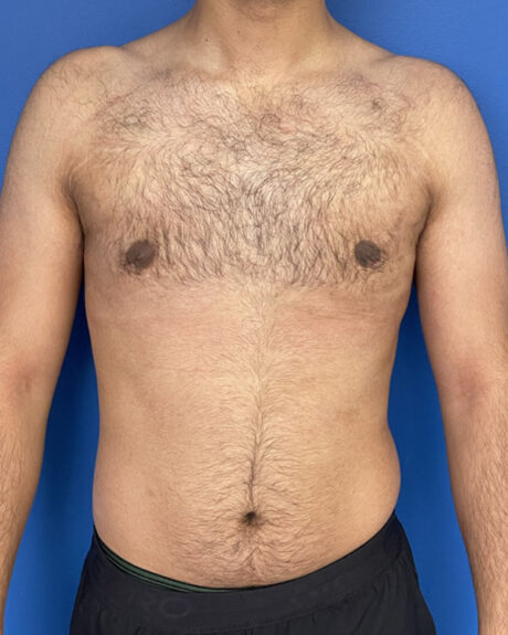 Gynecomastia case #3009