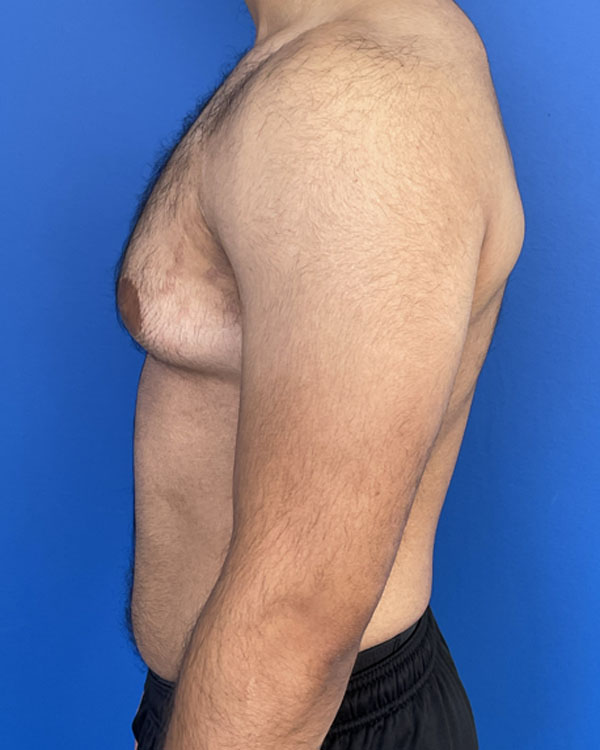 Gynecomastia case #3009