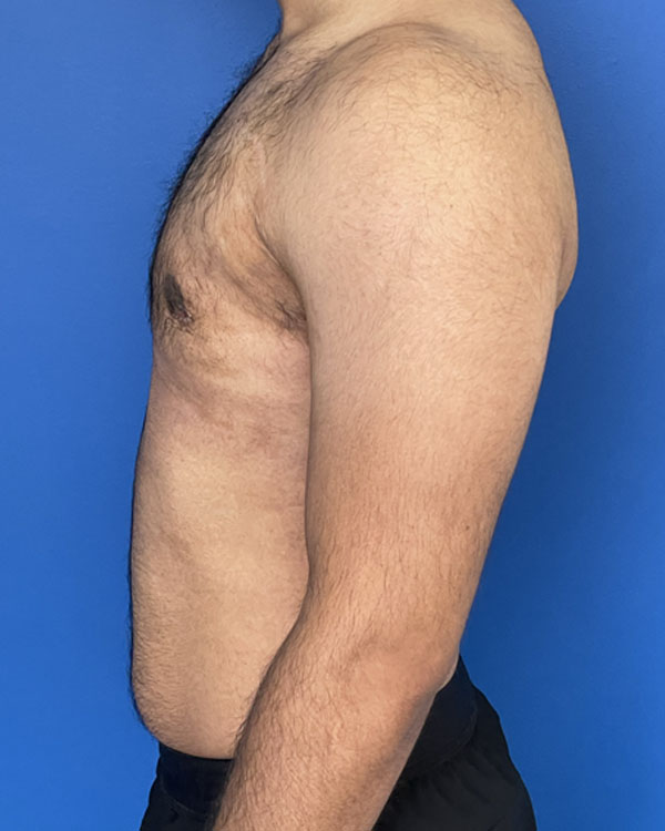 Gynecomastia case #3009