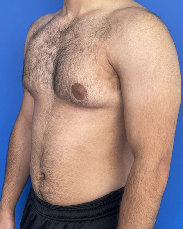 Gynecomastia case #3009