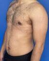 Gynecomastia case #3009