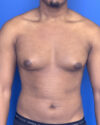 Gynecomastia case #3008