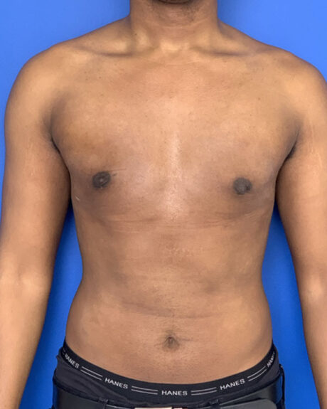 Gynecomastia case #3008