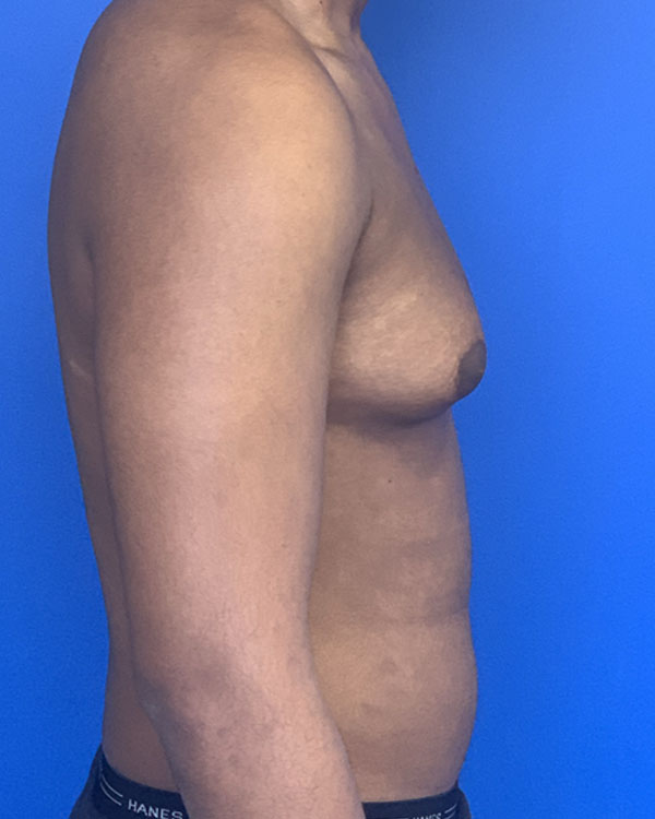 Gynecomastia case #3008