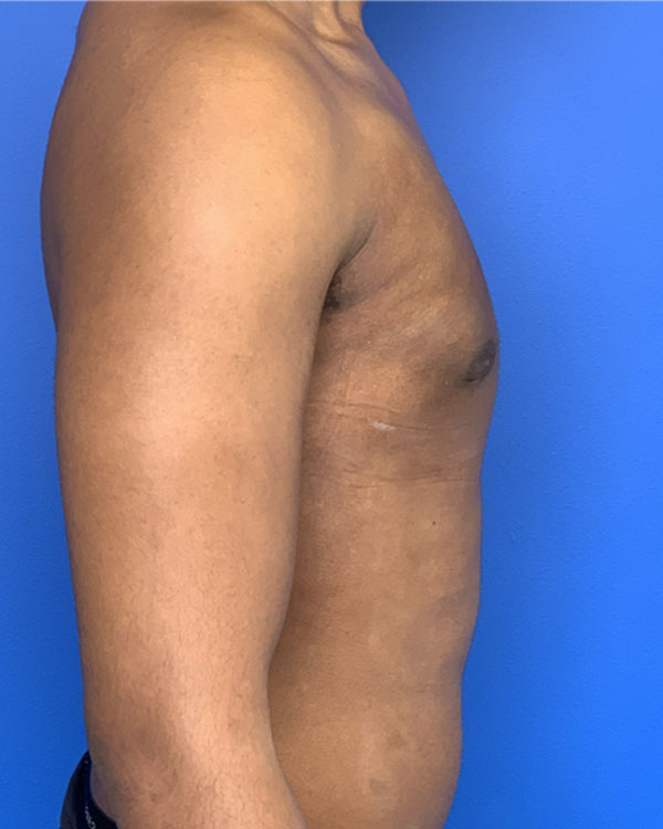 Gynecomastia case #3008