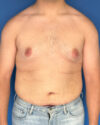Gynecomastia case #3981