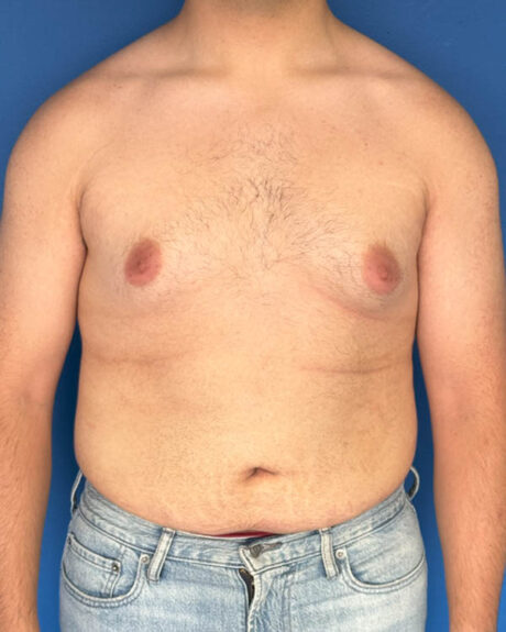 Gynecomastia case #3981