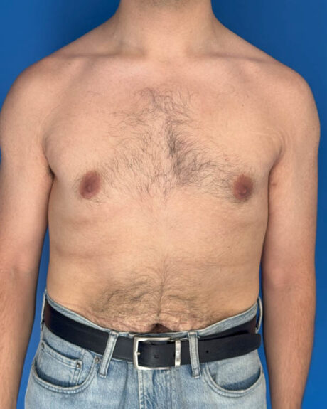 Gynecomastia case #3981