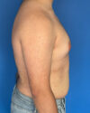 Gynecomastia case #3981