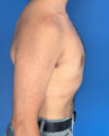 Gynecomastia case #3981
