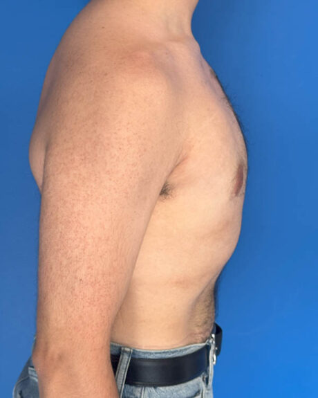 Gynecomastia case #3981