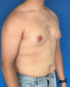 Gynecomastia case #3981