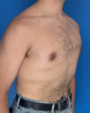 Gynecomastia case #3981