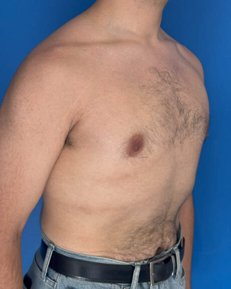 Gynecomastia case #3981