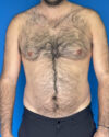Gynecomastia case #3988