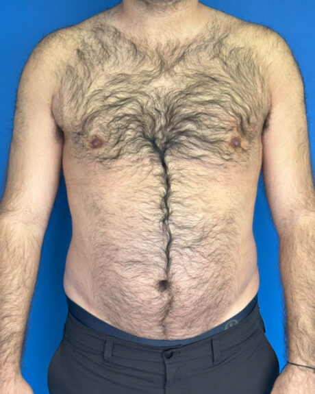 Gynecomastia case #3988