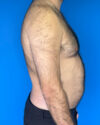 Gynecomastia case #3988