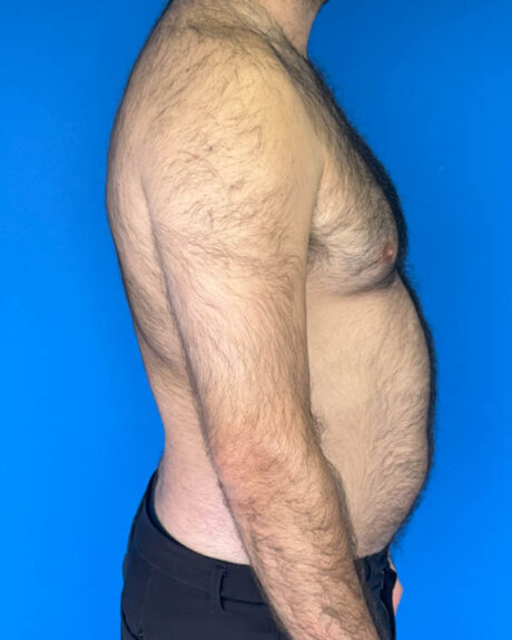 Gynecomastia case #3988