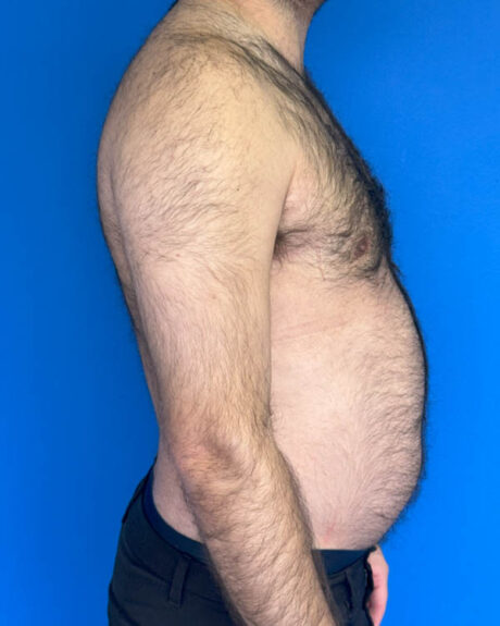 Gynecomastia case #3988
