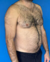 Gynecomastia case #3988