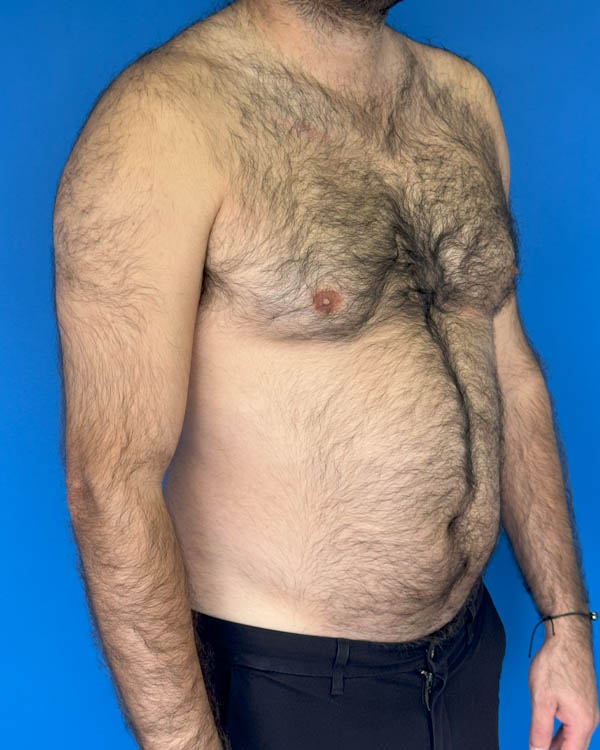 Gynecomastia case #3988