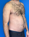 Gynecomastia case #3988