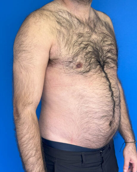 Gynecomastia case #3988