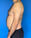 Gynecomastia case #3988